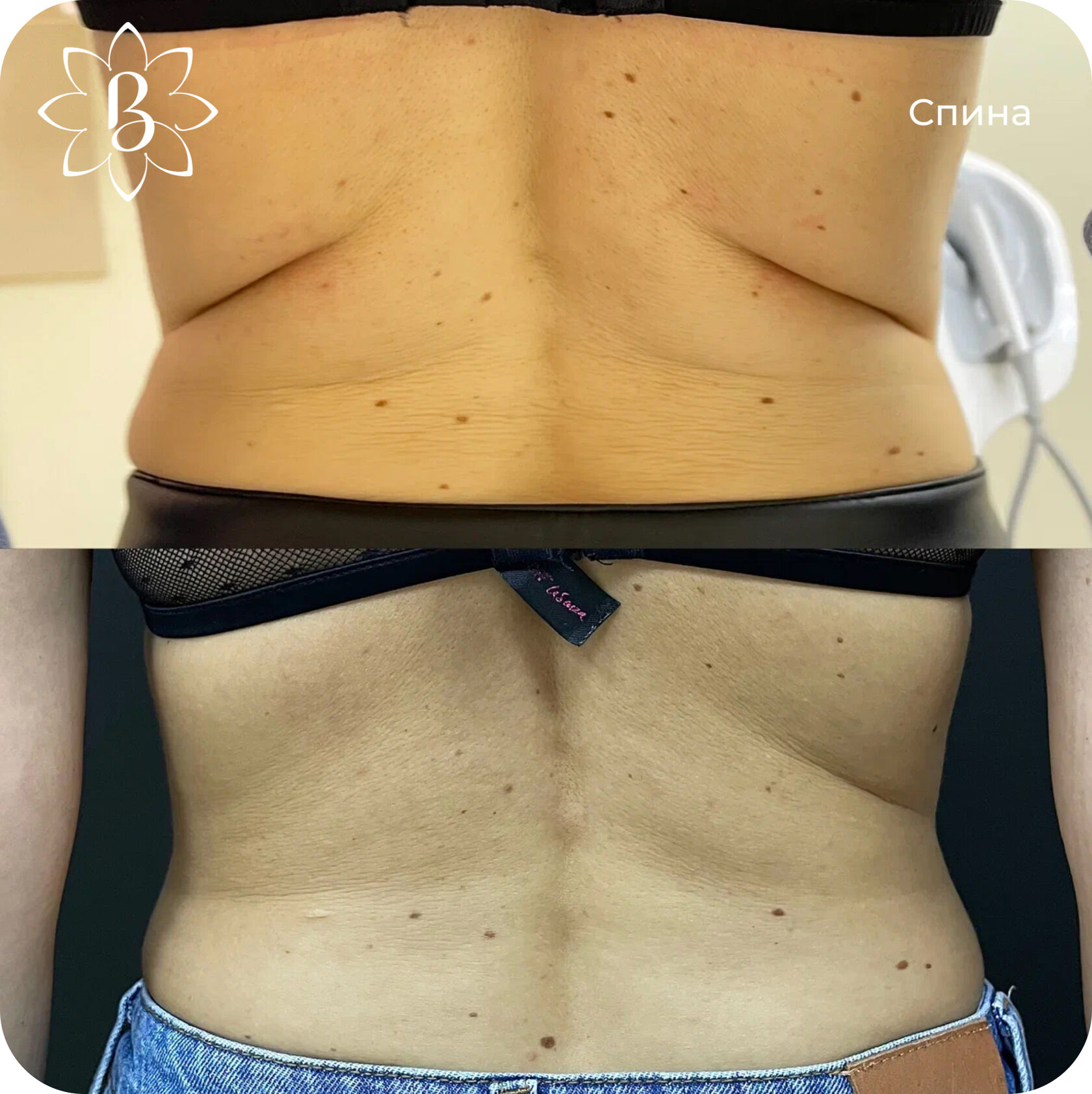 Диодная лазерная эпиляция СПб