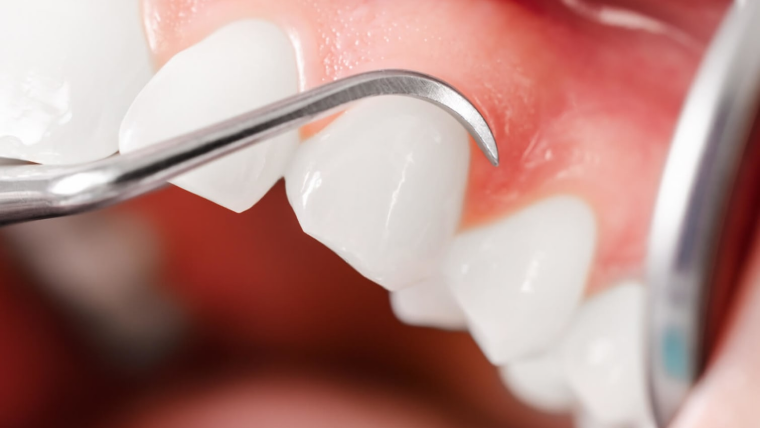 Лечение пародонтита — цены в Дербенте. Стоматологическая клиника DK