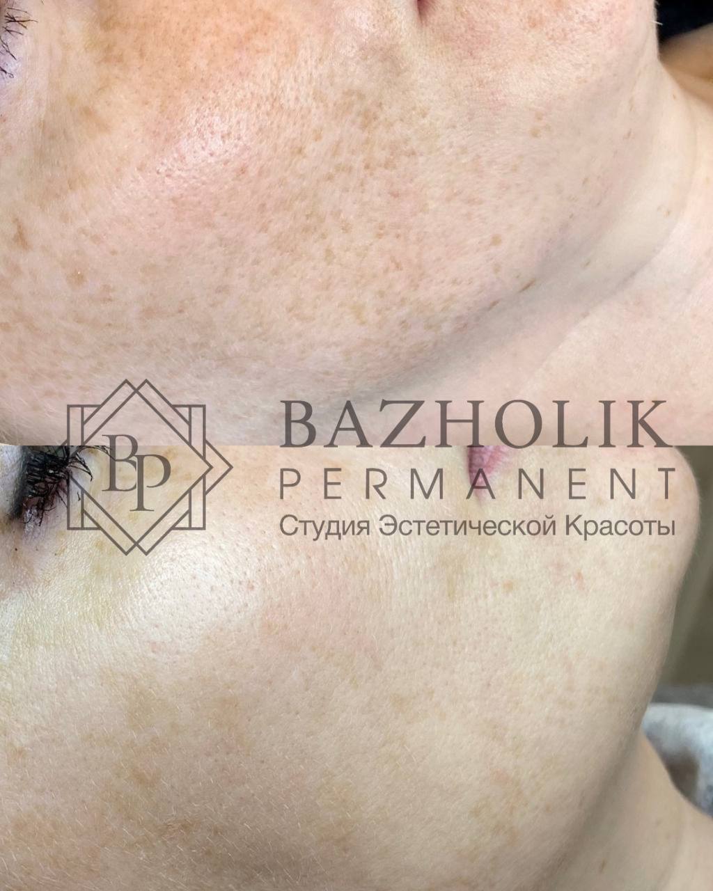 как убрать пигментные пятна на лице , пилинг , пигментация на лице , методы удаления пигментных пятен