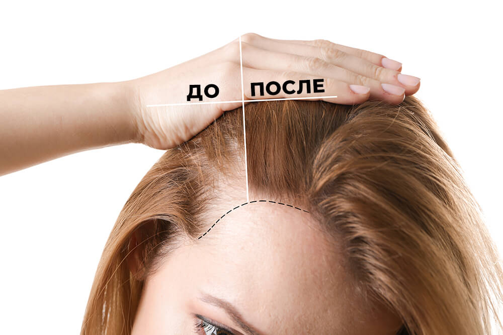 до и после мезотерапии xl hair