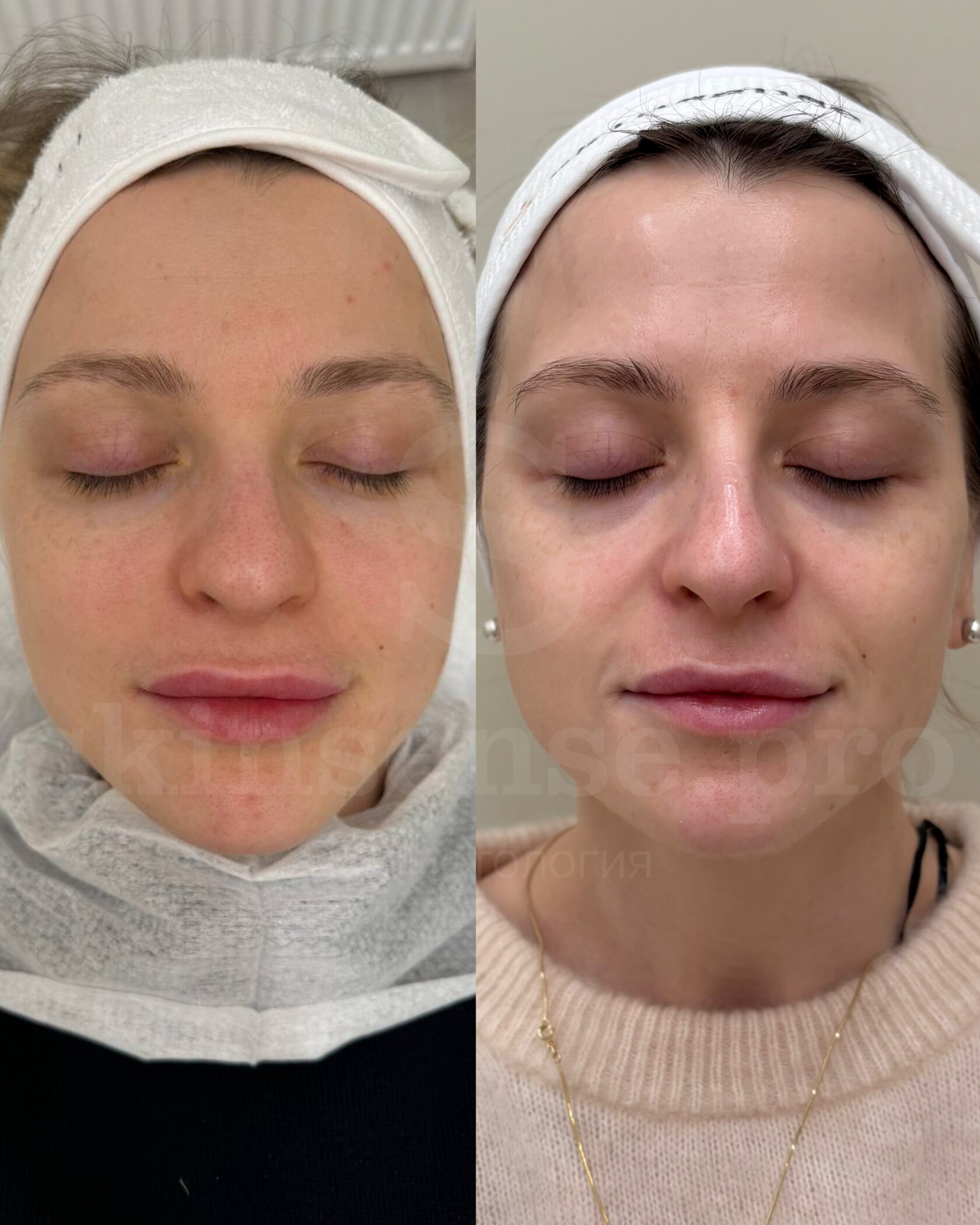 Результат пациентки Skinsense после чистки лица и курса пилингов