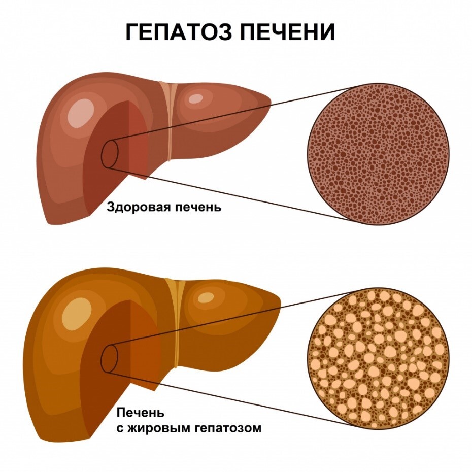 Здоровая печень и печень с жировым гепатозом