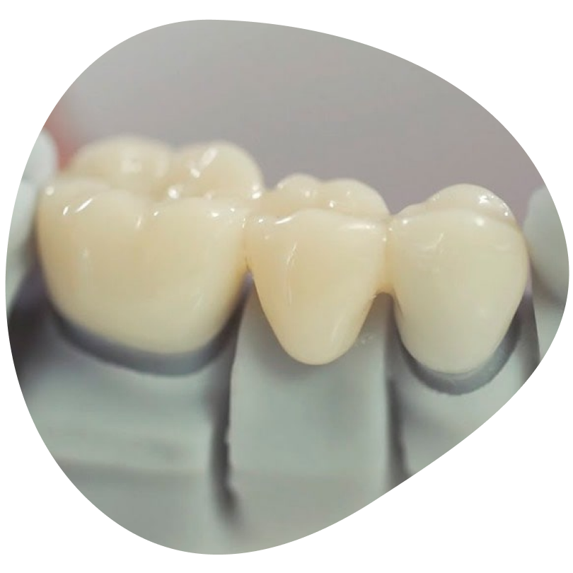 Протезирование зубов | Стоматология «АЛЕКСАНДРиЯ»