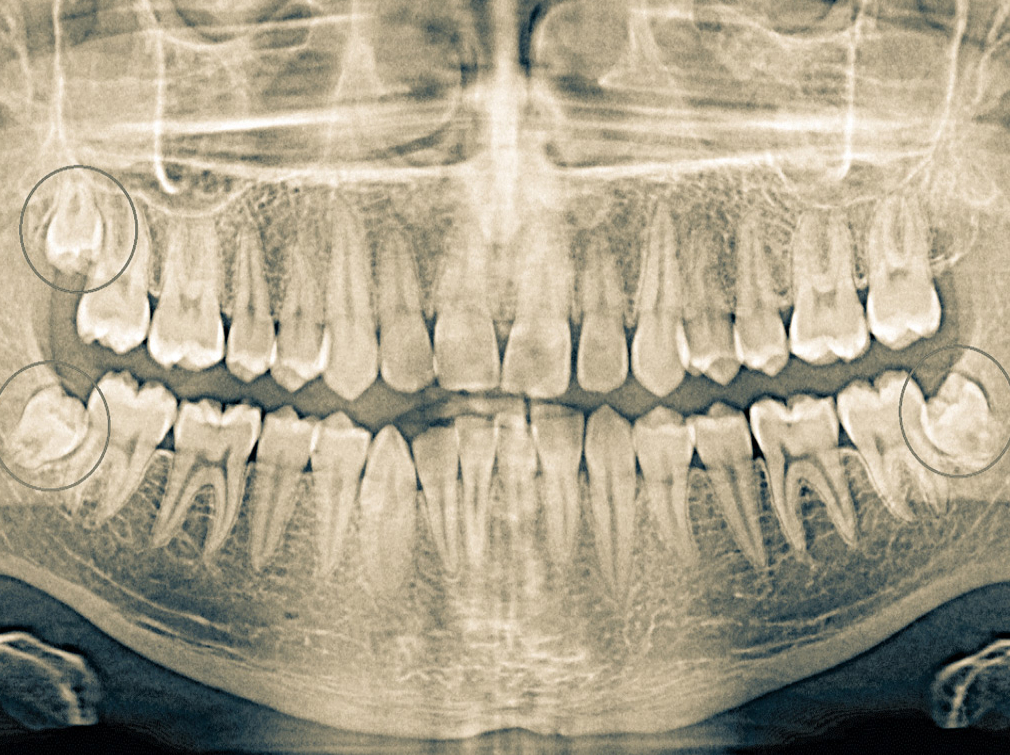 Удаление зубов мудрости перед установкой брекет-системы