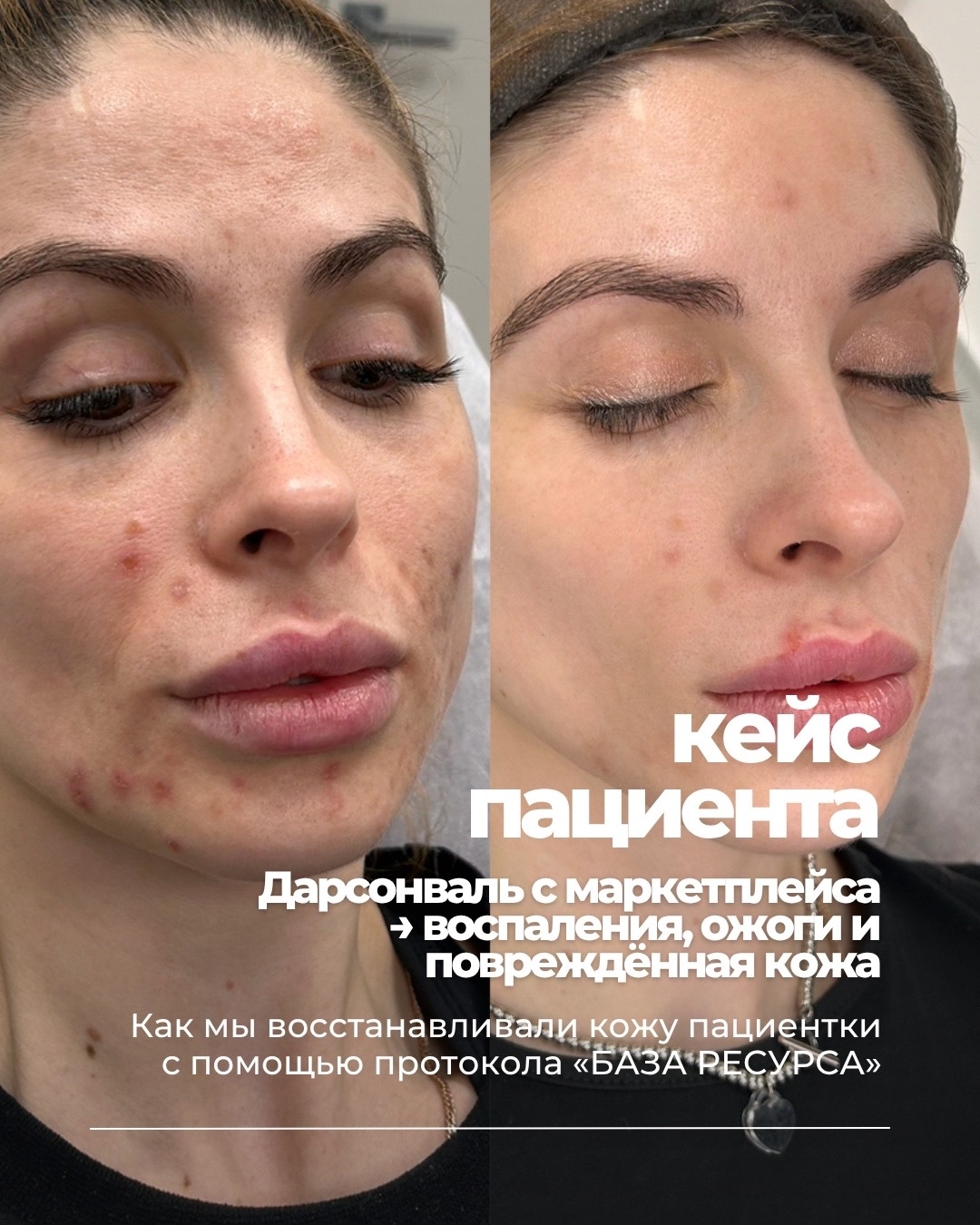 Кейс пациентки: восстановление кожи плазмотерапией