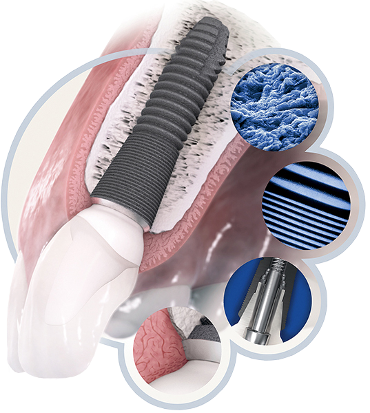 имплант зуба