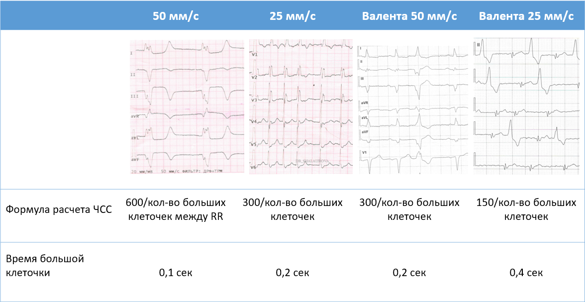 Как посчитать скорость экг. Как посчитать ЧСС на ЭКГ. Посчитать ЭКГ по клеточкам. Как посчитать ЧСС на ЭКГ по клеточкам. Формула расчета ЧСС по ЭКГ.