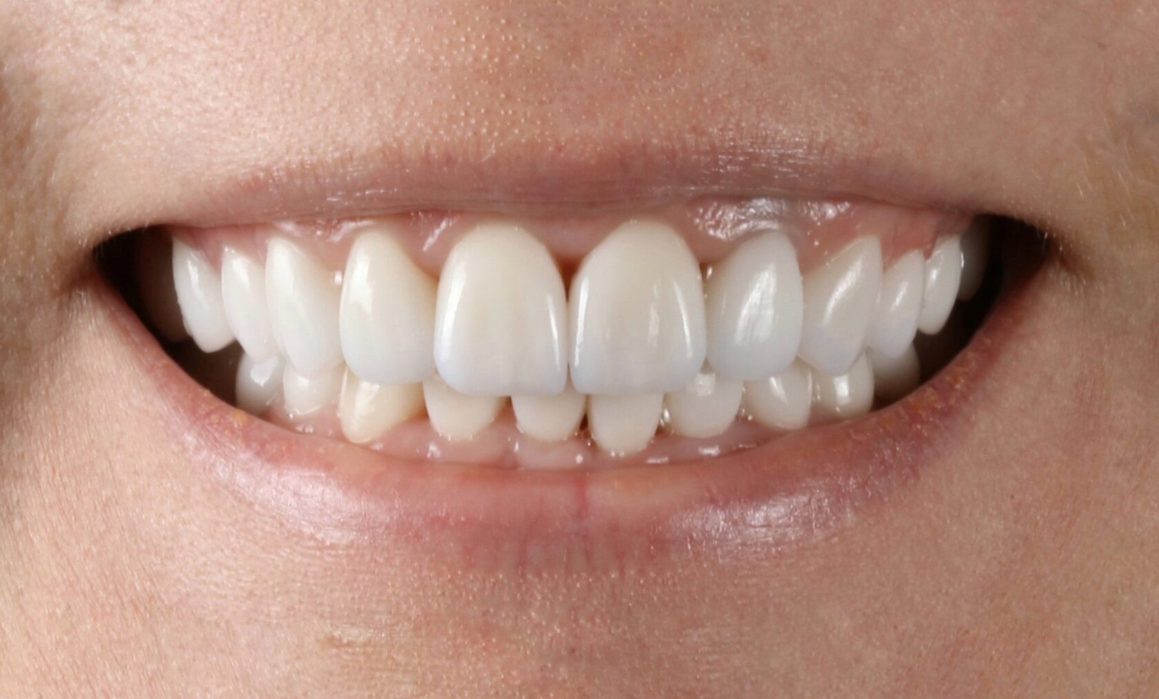 вернуть красивую улыбку и белые зубы в клинике Пробел