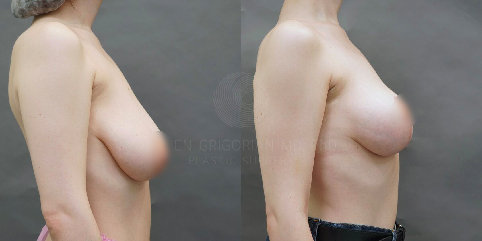 уменьшается грудь во время беременности фото 23