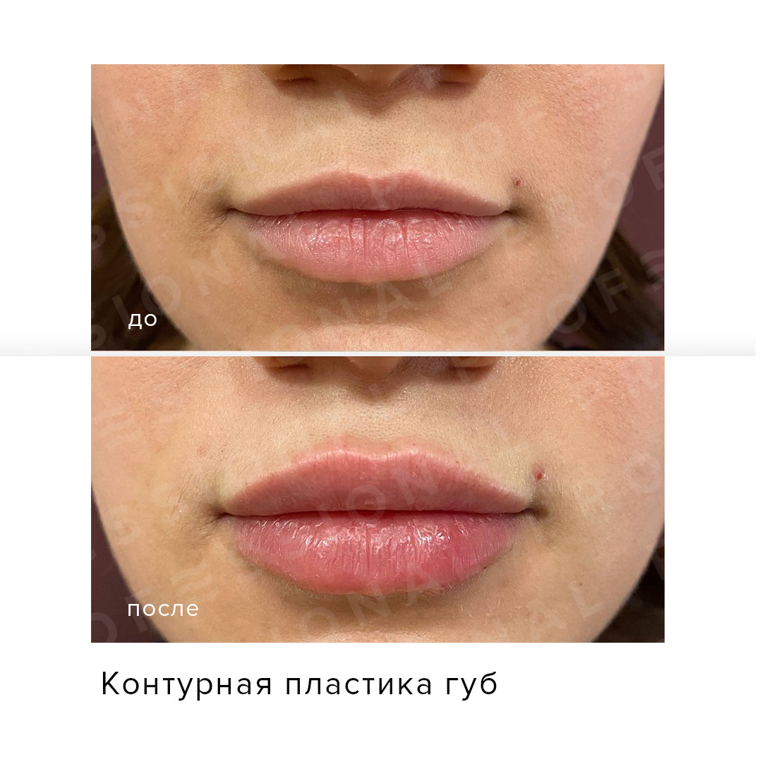 Фото губ до и после контурной пластики фото