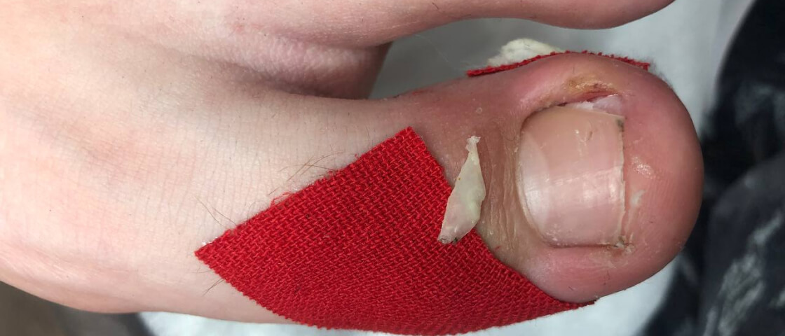 Вросший ноготь, деформация ногтевой пластины, вросший ноготь лечение, деформация ногтей причины, вросший ноготь симптомы, деформация ногтей фото, вросший ноготь как лечить, деформация ногтей лечение, как избавиться от вросшего ногтя, как исправить деформацию ногтей