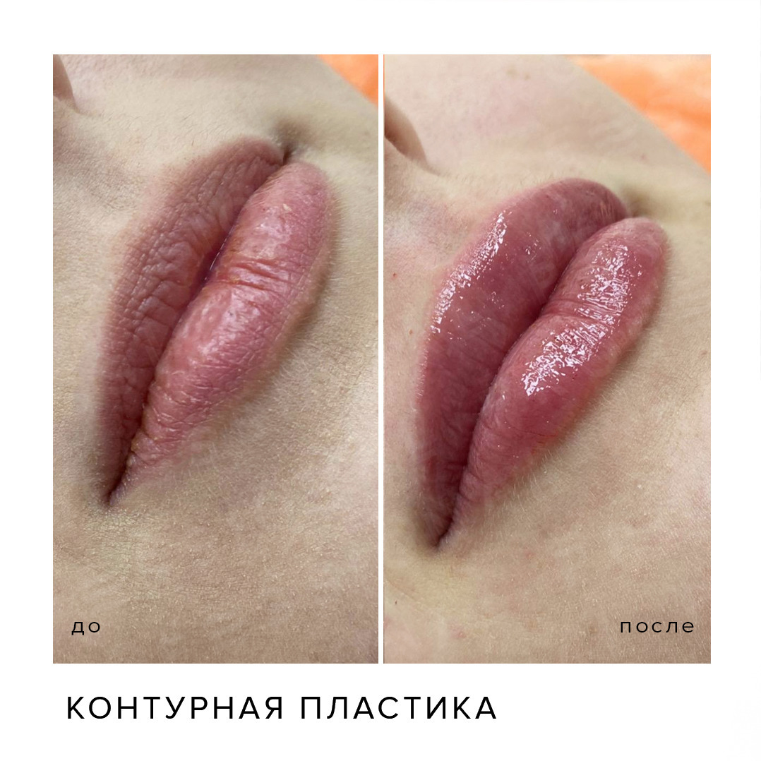 Деликатная коррекция губ ?