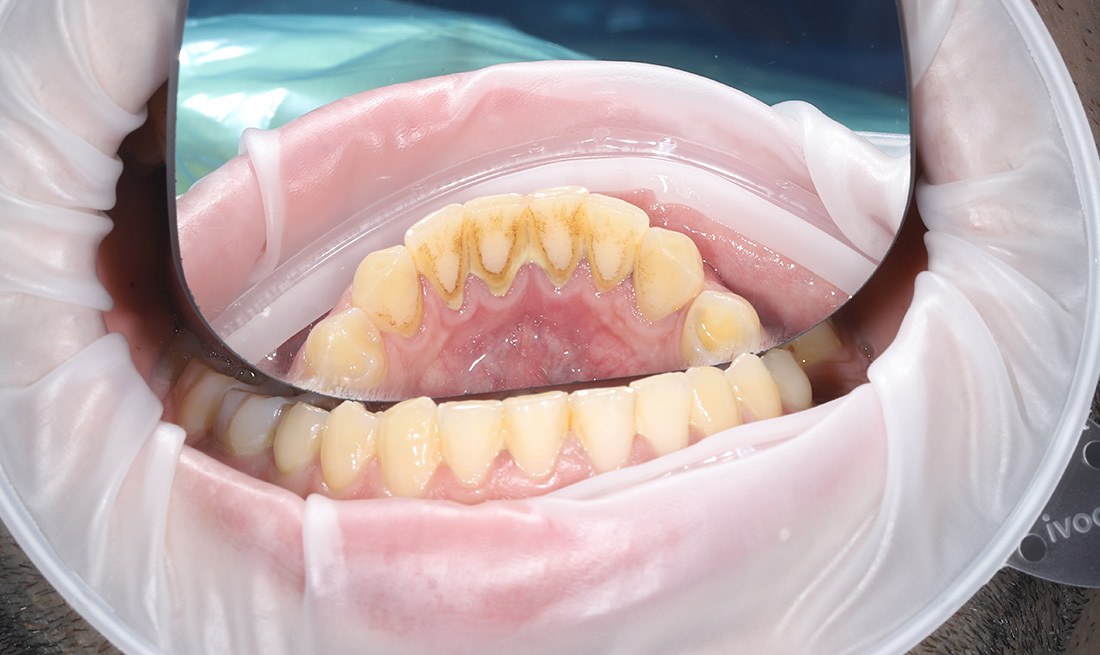 Профессиональная чистка зубов Air Flow и ультразвуком