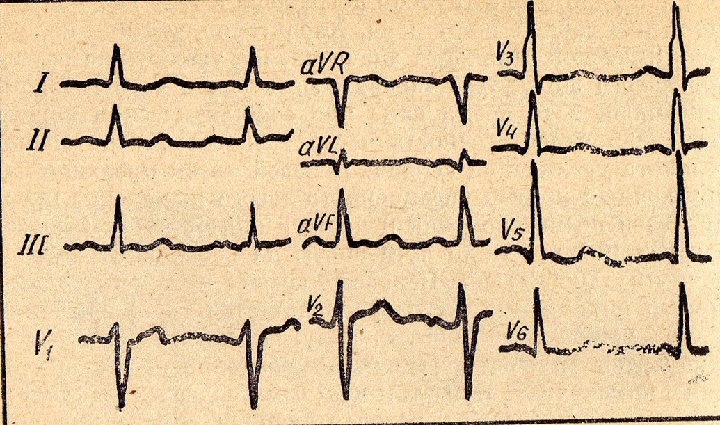 Аортальные пороки. Часть 2 Аортальная недостаточность