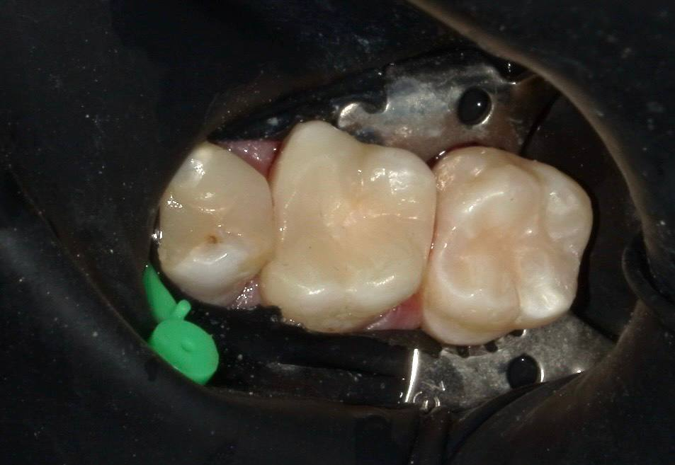 Несостоятельная пломба и скрытый кариес