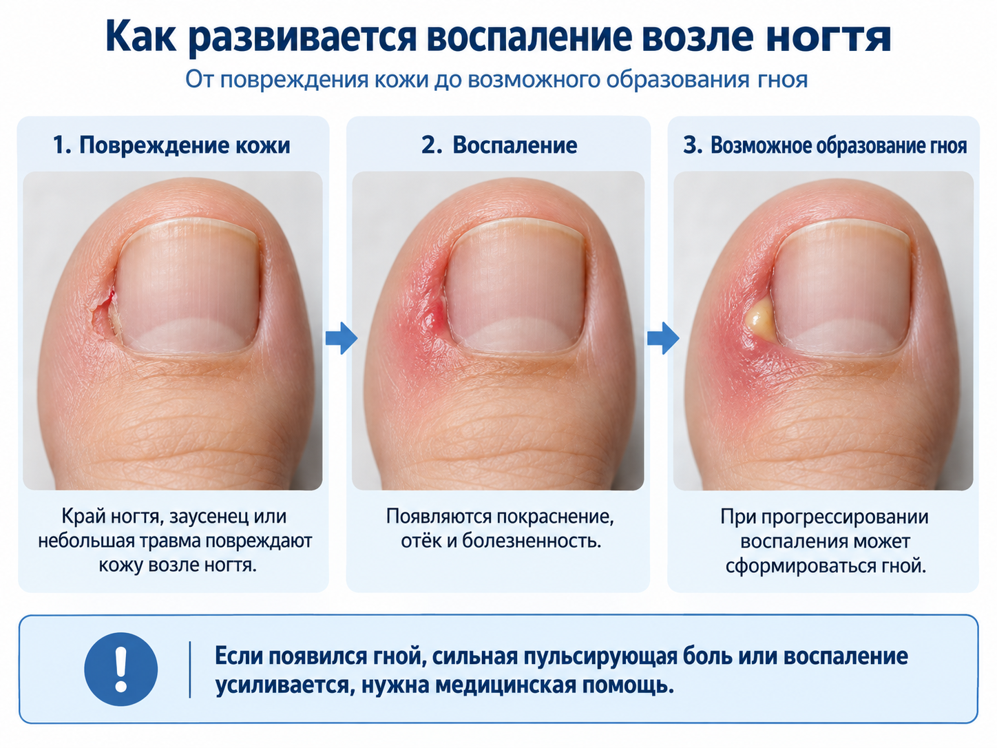 Как развивается воспаление возле ногтя