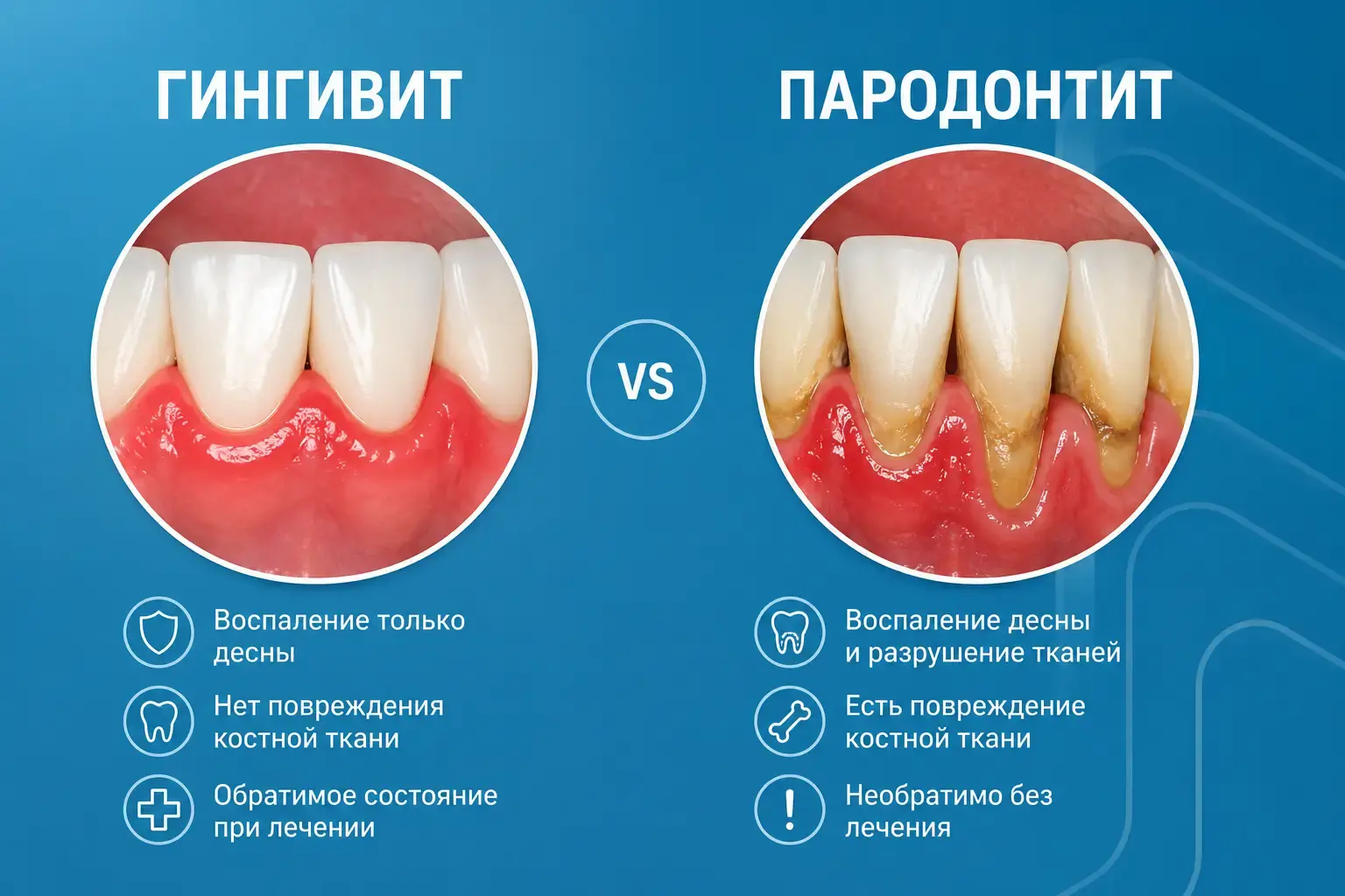 Гингивит и пародонтит - Отличия