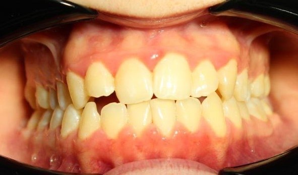 Фронтальный вид до лечения на элайнерах Star Smile