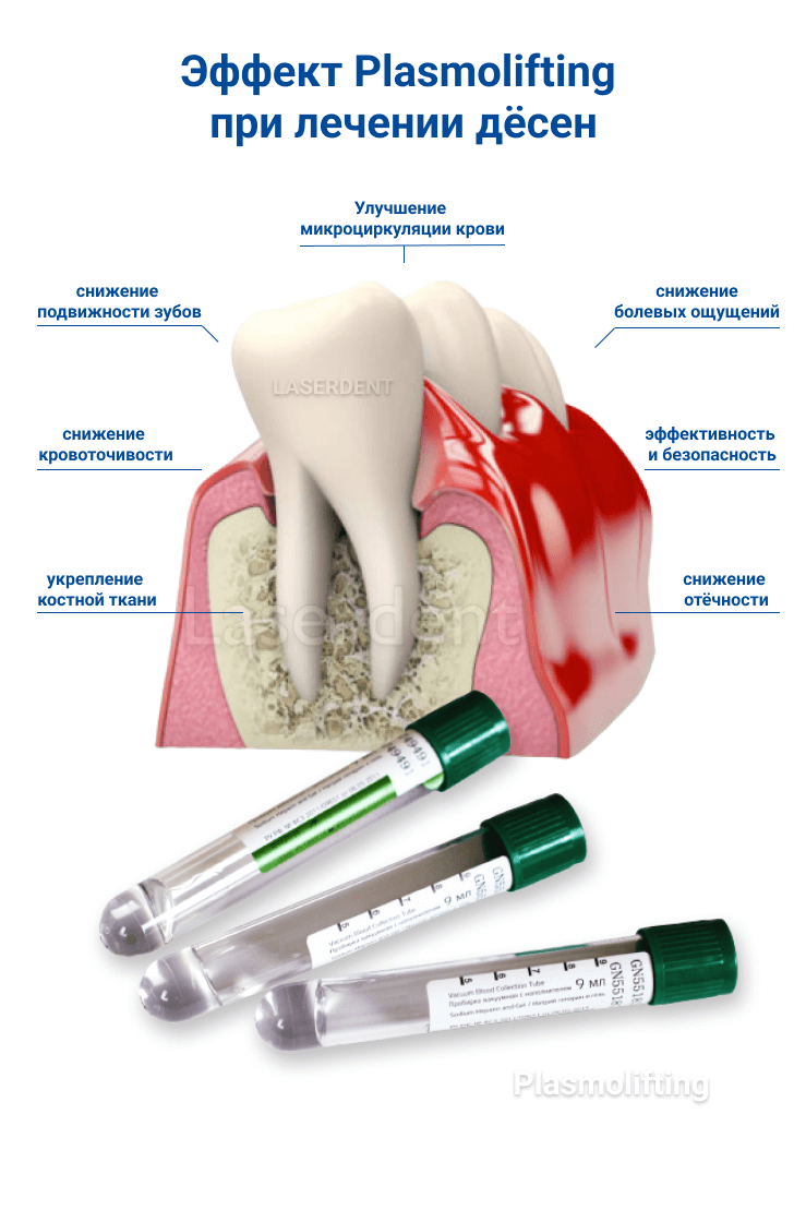 Лечение Дёсен в Стоматологии Лазердент Хабаровск