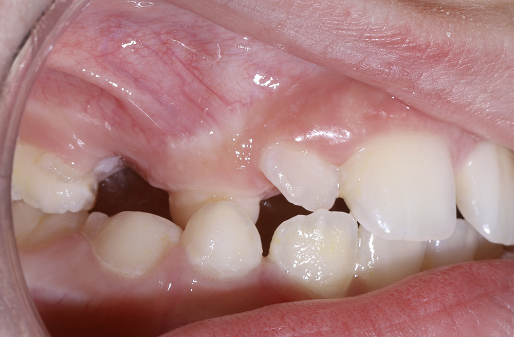 Лечение на ортодонтической съемной пластинке у ребенка