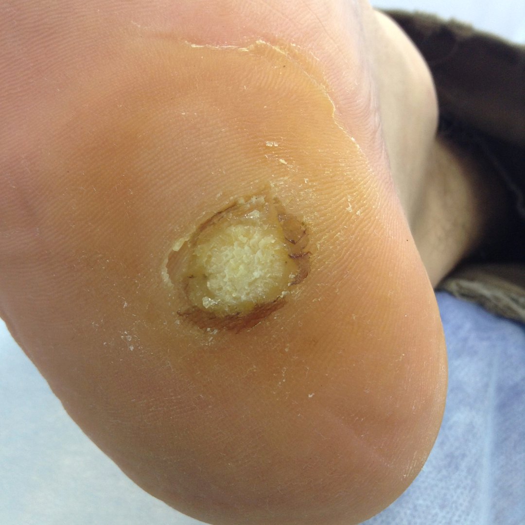 Подошвенная бородавка