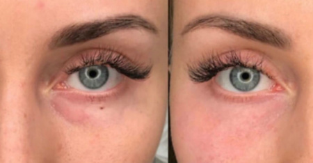 Фото 1. Эффект после препарата Meso Eye C71 до и после