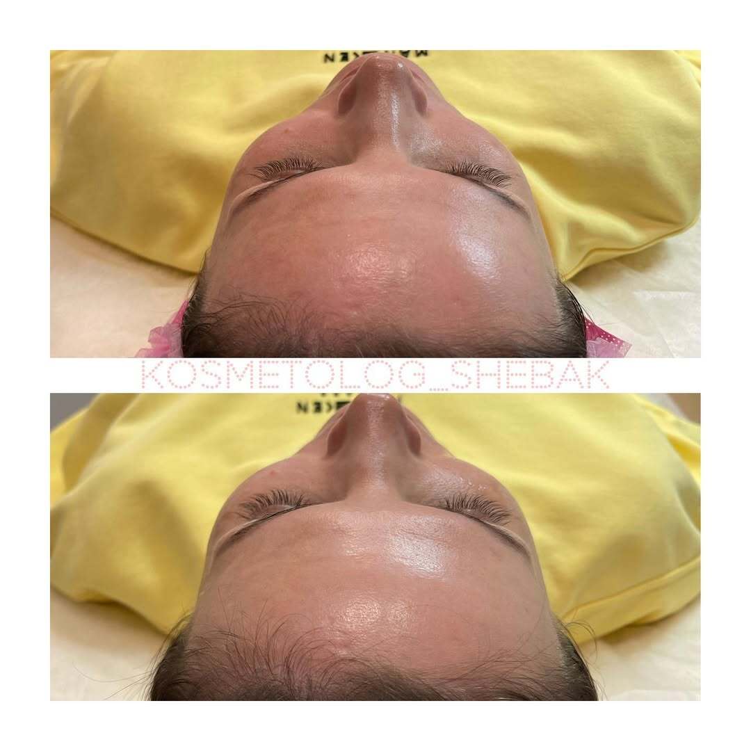 Контурная пластика лица в клинике PradusCOSMO, Санкт-Петербург. Естественный результат без эффекта переделанного лица