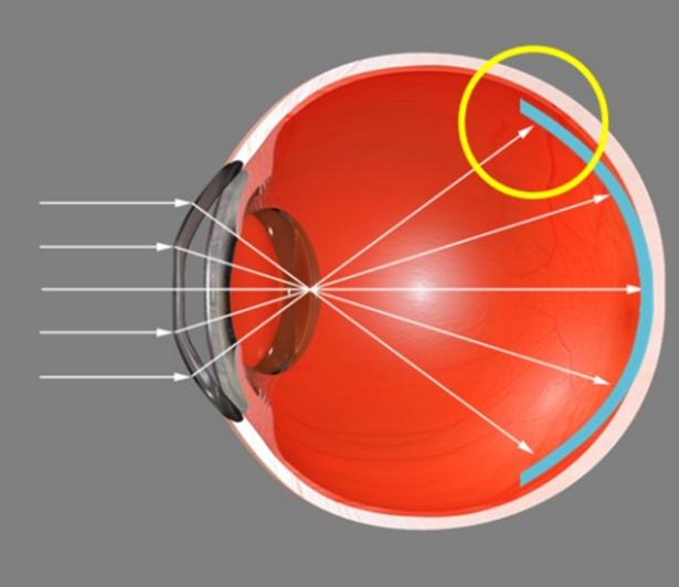 Чёткое изображение фокусируется перед сетчаткой. Дефокусные линзы. Оптика глаза. Линзы для замедления прогрессирования миопии. Лучи света фокусируются за сетчаткой