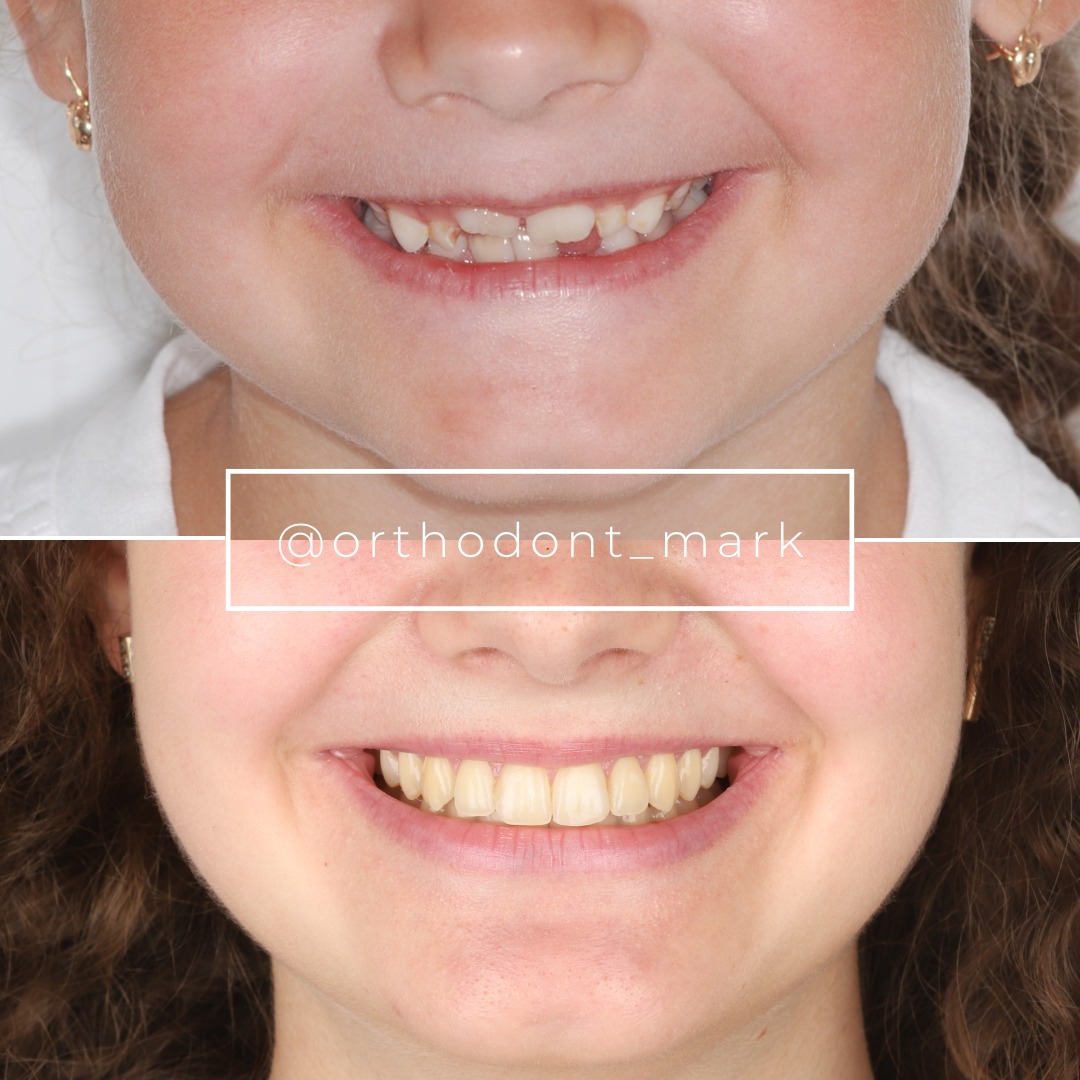 From Preventive Expansion at Age Six to Comprehensive Treatment