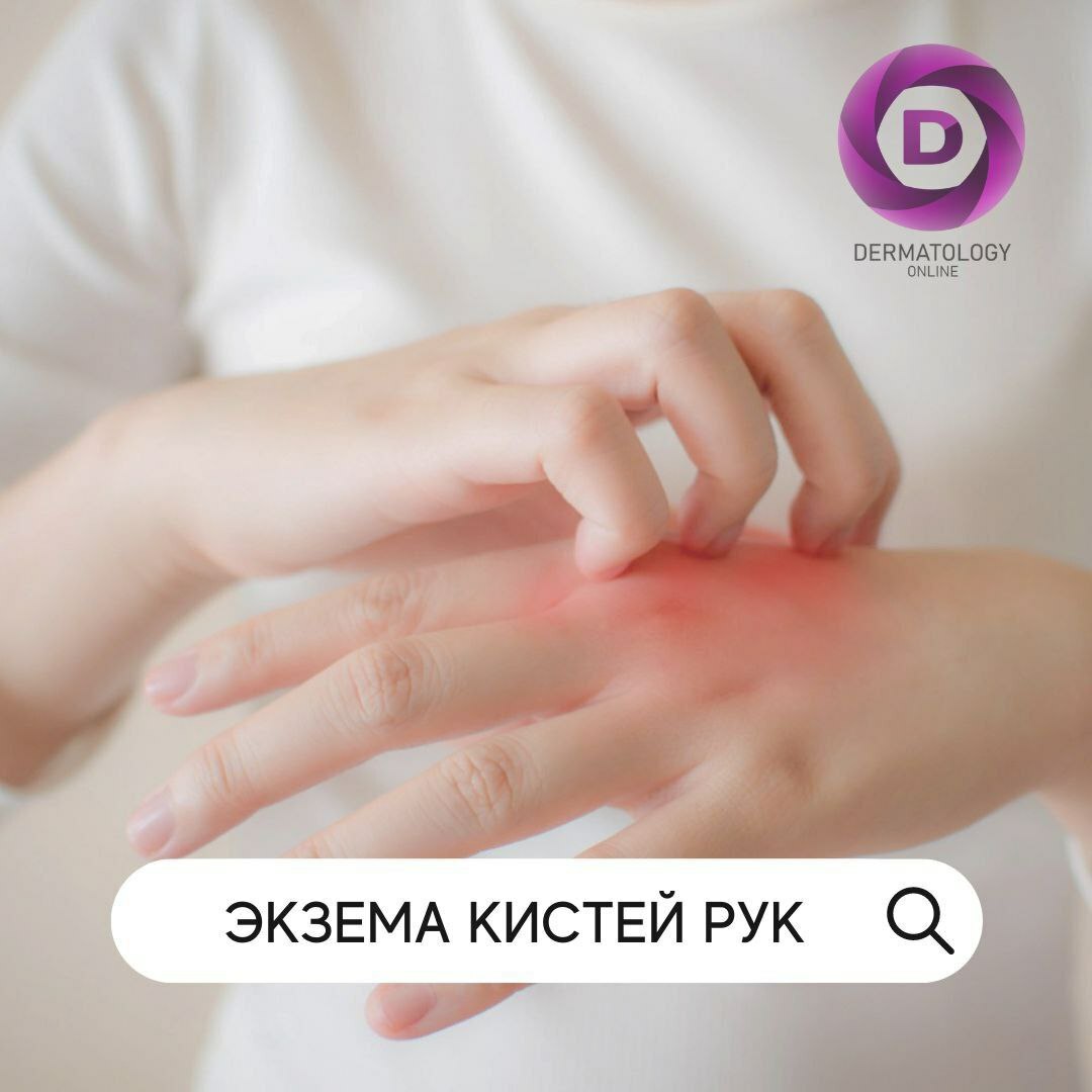 Экзема кистей рук, причины, лечение, консультация