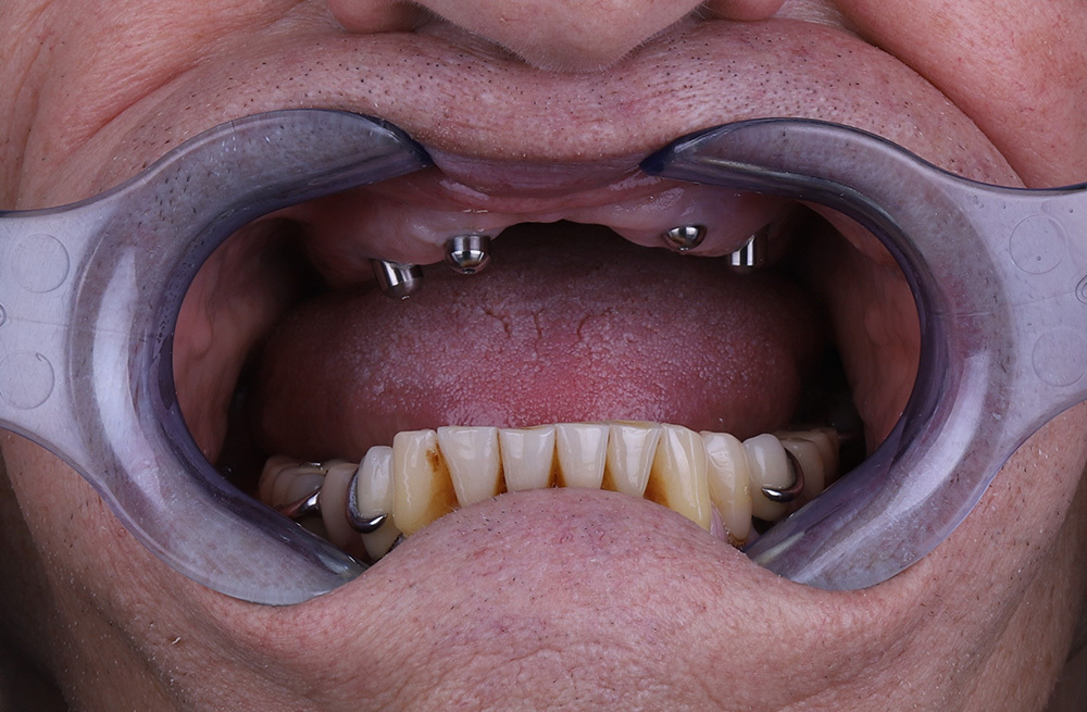 Установка имплантов Osstem на верхнюю челюсть