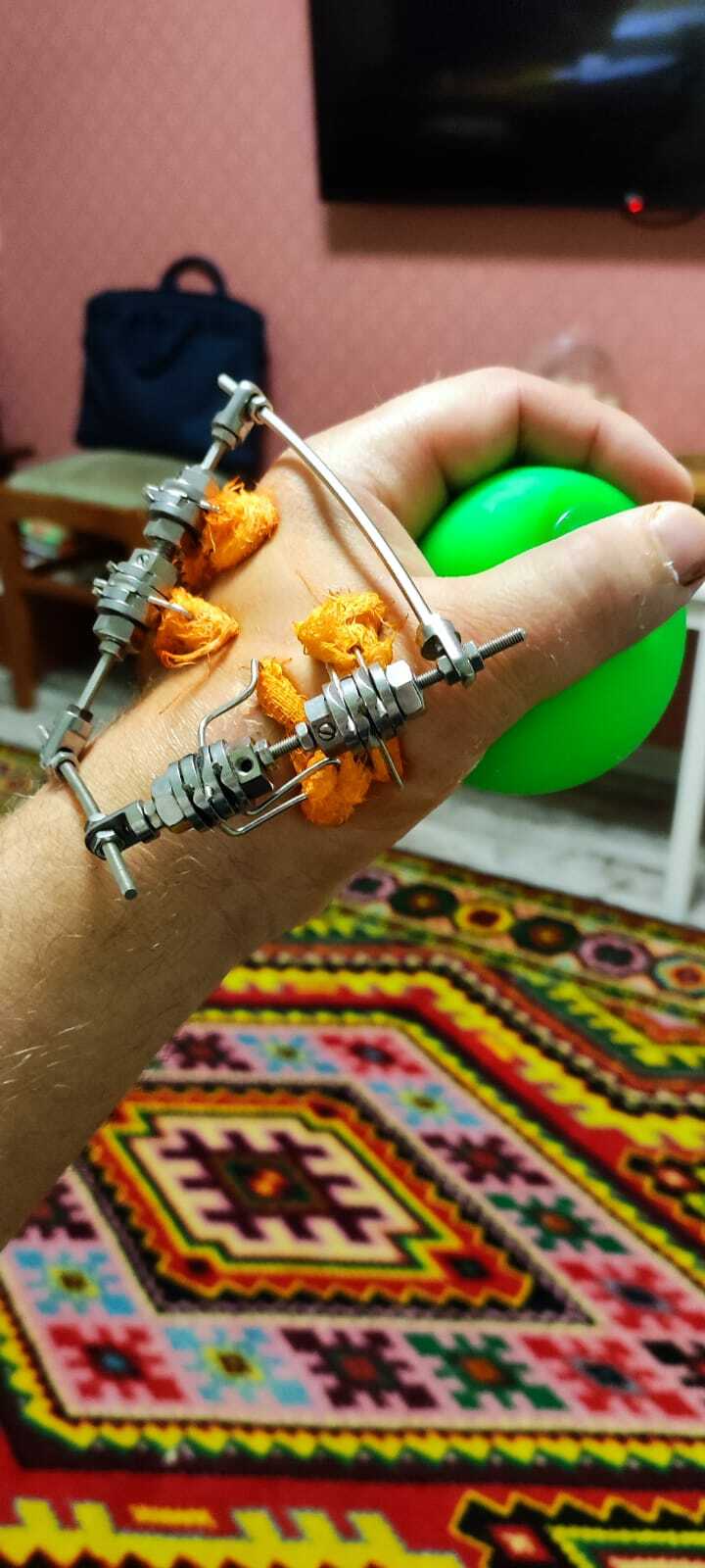 Мини-аппарат Илизарова