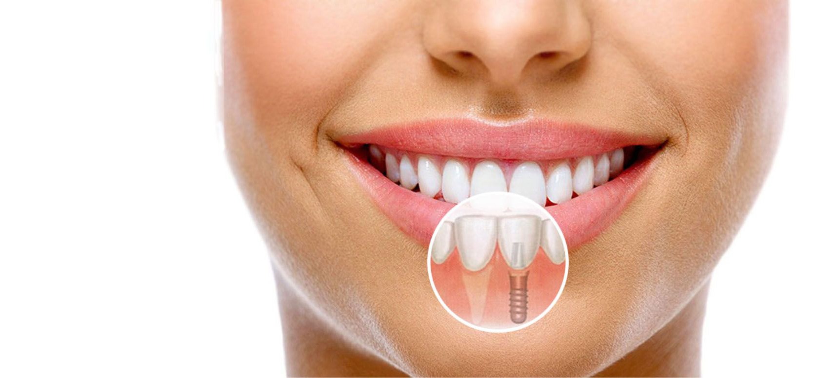 Имплантация зубов: ключ к восстановлению вашей улыбки