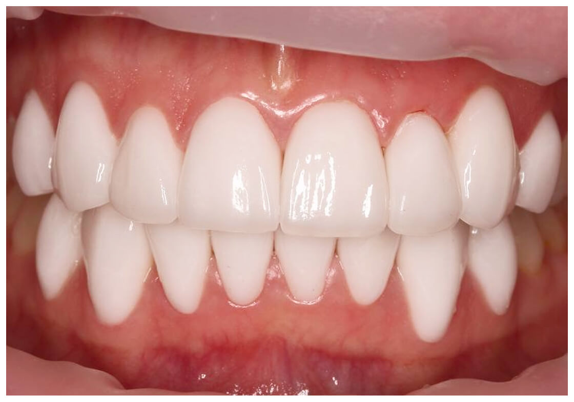 Работы до после в стоматологии Дент-Арт, имплантация