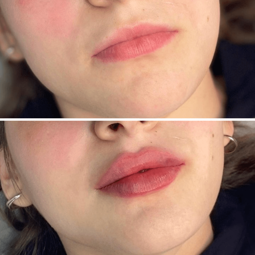 губы после гиалуроновой кислоты 0.5 мл фото