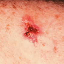 Pictures of skin cancer