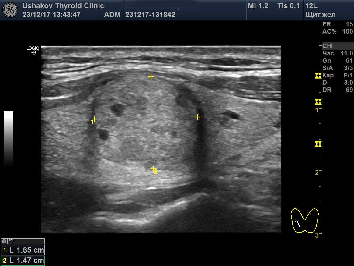Узел щитовидной железы ti rads 3. Что такое ACR ti-rads-3. Узел по УЗИ ti rads 2. Узлы щитовидной железы на УЗИ.