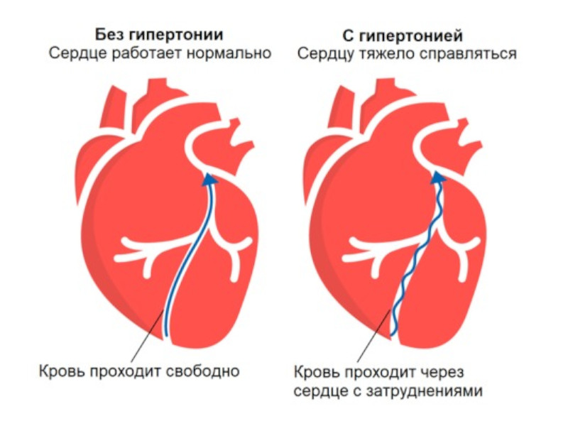 Гипертонический криз: при каком давлении вызывать скорую помощь