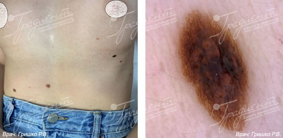 Раннее выявление меланомы, меланомы, выявленные в клиниках Вектор ...