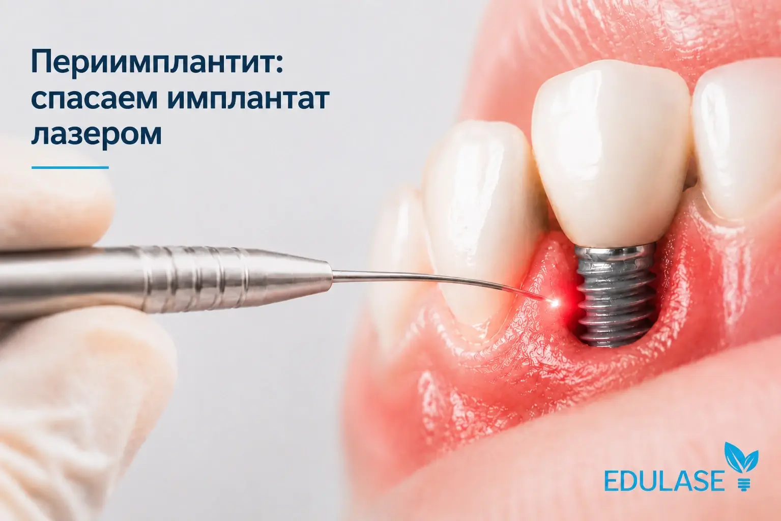 Лазерная деконтаминация имплантата при переимплантите – диодный лазер LIKA-surgeon