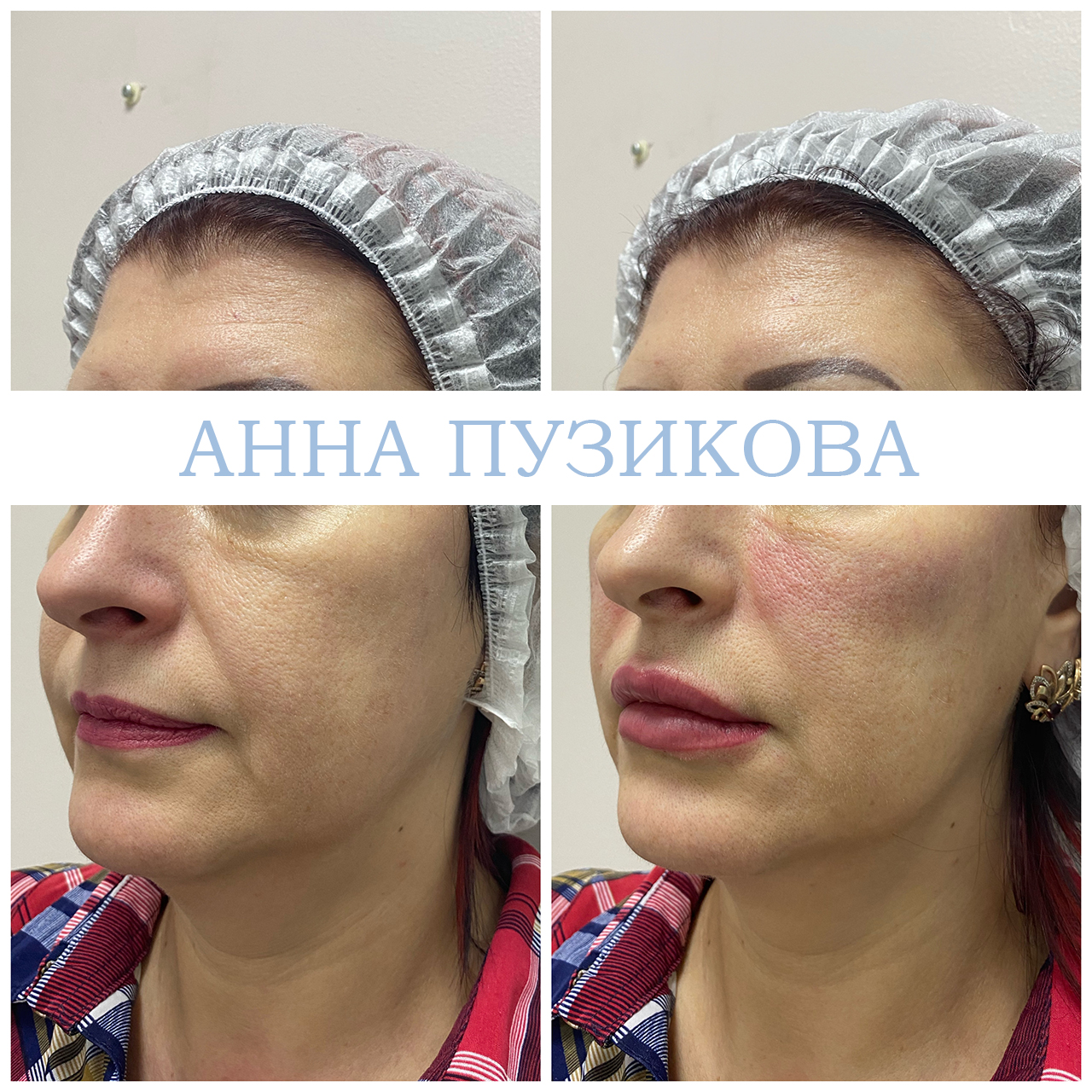 Фото до и после процедуры контурной пластики губ. Естественный результат после коррекции у косметолога Пузиковой Анны Анатольевны, клиника Прадус СПб.