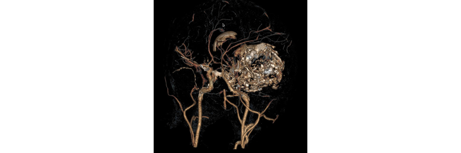 Тератома - Диагностика и лечение