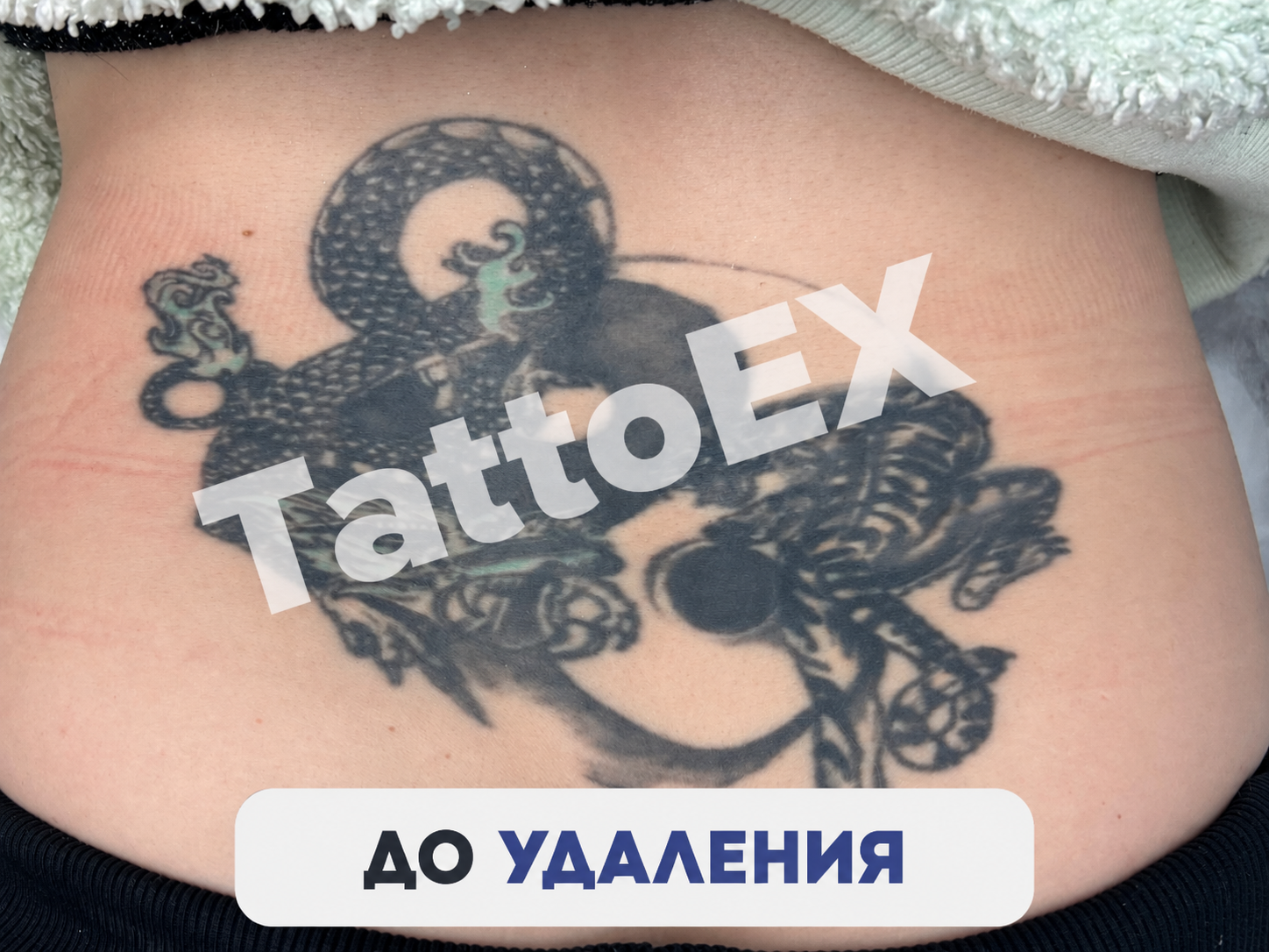 Удаление тату фото — татуировка перед сравнением лазеров