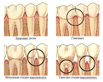 Ноют и болят передние нижние (верхние) зубы: первая помощь