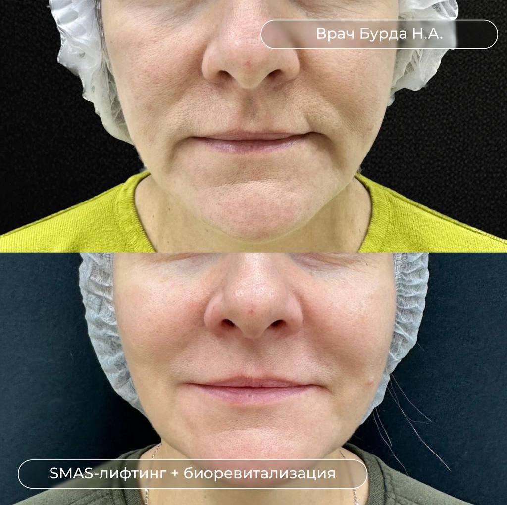 Результат процедуры криолиполиза и процедур Icoone Laser