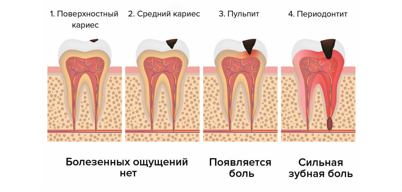 Клинические проявления острого периодонтита