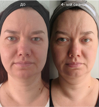 Результат: четкий овал лица