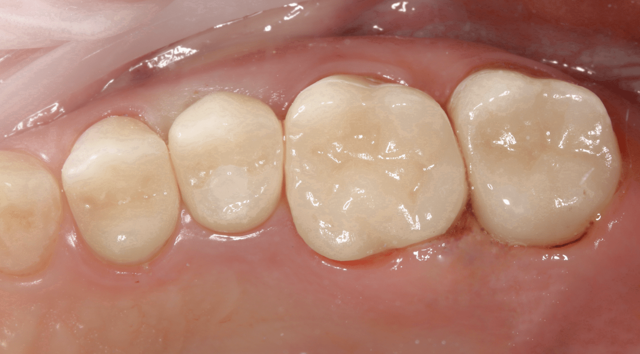 Установка импланта зубов в Москве – стоматология Probel