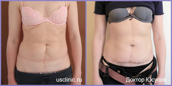 Cost Of Tummy Tuck Breast Enlargement And Hip Adjustment Top Sellers www.beztaba