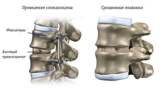 Виды операций по спондилодезу позвоночника